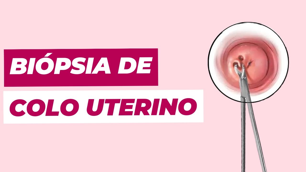 Tudo sobre biópsia de colo uterino