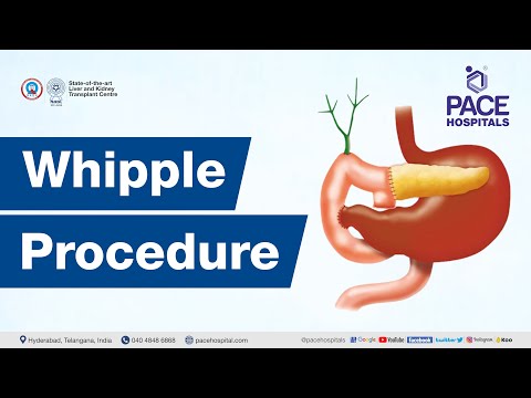 The Whipple Procedure | Indications, Steps, Success Rate and Complications