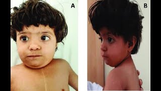 Prominent forehead (frontal bossing), flat nasal bridge, wide set eyes (hypertelorism)