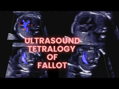 Ultrasound identification Tetralogy of Fallot. Congenital fetal heart abnormalities.