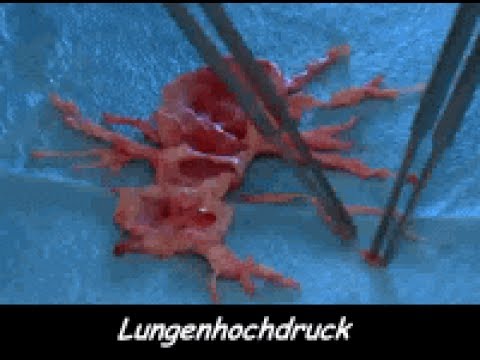 Hypertensive Krise Carvedilol Blutdruck Alkohol
