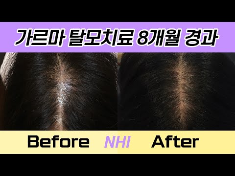 정수리탈모치료 정수리모발개선 240일 경과 I 뉴헤어 I 모발이식 I 탈모치료 I Before&After