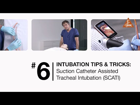 Suction Catheter Assisted Tracheal Intubation (SCATI)