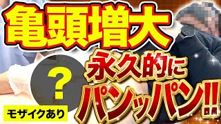 【雄のカリ！】永久的に亀頭がパンパンになる治療をノーカットでお届け【モザイクあり】