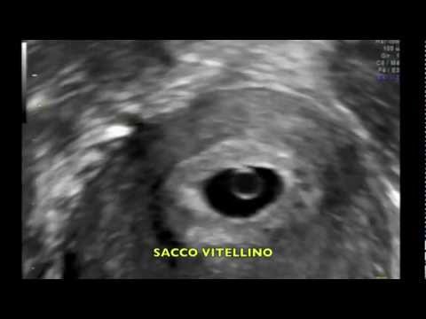 Brace benda sul polso 26-27 settimane di gravidanza, il mal di schiena