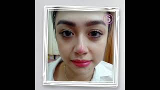 Download lagu Hidung Mancung Permanen Tanpa Operasi di Klinik INDLEA Bandung mp3 Download lagu Hidung Mancung Permanen Tanpa Operasi di Klinik INDLEA Bandung mp3