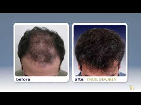 Medication That Causes Hair Loss Manhattan, NYC - True & Dorin Medical Group