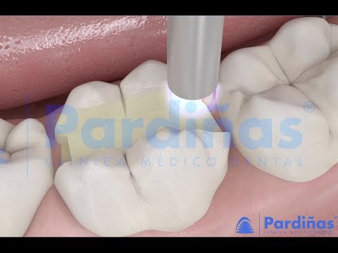 Incrustacións dentarias ©