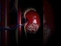 किडनी कैसे खराब होती है How Kidneys Get Damaged In Easy To Und