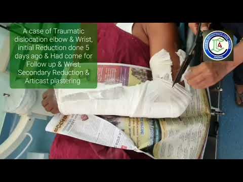 Wrist Fractures | Communited fracture LE Radius | Closed reduction fractures | Adamya Hospital Video