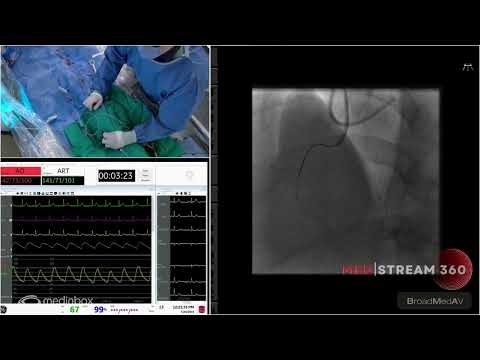 CTO of RCA Using Antegrade Approach
