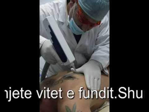 Heqje Tatuazhi Me Lazer
