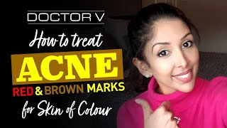 Doctor V - How To Treat Acne Red & Brown Marks for Skin of Colour | Brown/ Black skin