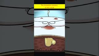 The formation process of skin acne