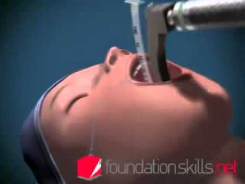 Endotracheal Intubation   Animated