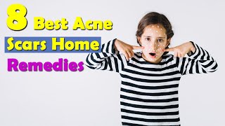 How To Get Rid Of Acne Scars Overnight -  8 Best Acne Scars Home Remedies
