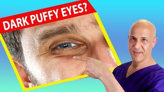 Get Rid of Dark Puffy Eyes the Simple Way | Dr. Mandell