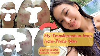 2020  Skincare Products for Combination & Acne Prone Skin