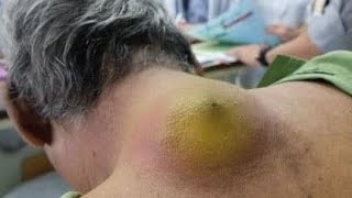 Huge cyst on neck