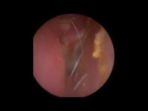 Ear Wax Removal using Jobson Horne (Ear Spoon) - Mr Neel Raithatha (The Hear Clinic)