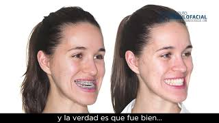 Cirugía ortofacial. Caso # 95: María - Clase III, hipoplasia maxilar, mordida abierta severa