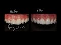 Simple Ortho and Peg Lateral Bond Up