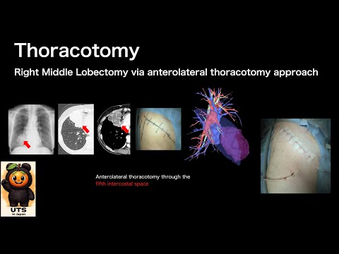 【#161】Thoracotomy, right middle lobectomy via anterolateral thoracotomy approach
