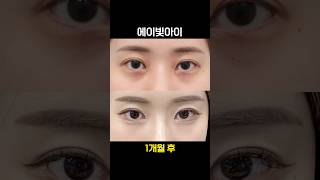 컨실러 보다 나은 다크서클 주사