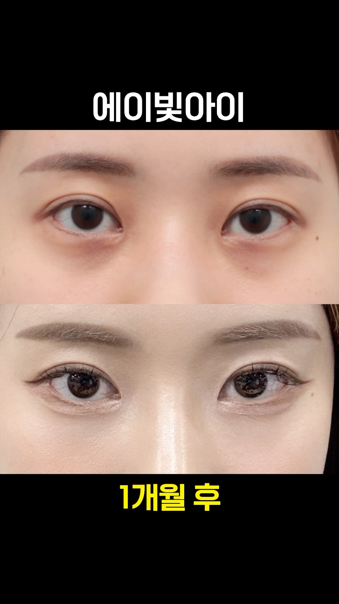 컨실러 보다 나은 다크서클 주사