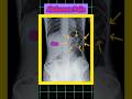 Abdomen Gas Cause Abdomen Pain Medicalimaging