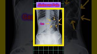 Abdomen Gas cause abdomen pain #medicalimaging