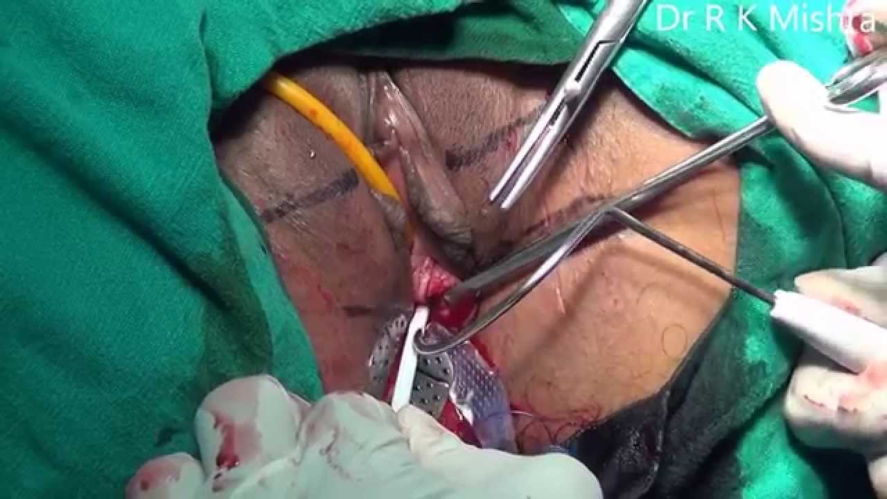 Tension free Vaginal Tape Obturator (TVTO)
