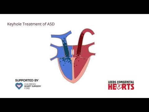 Atrial Septal Defect and Keyhole Treatment