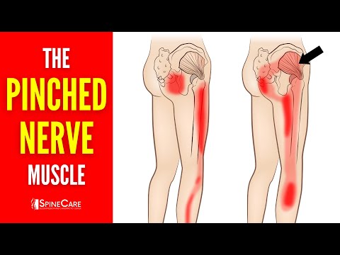 The Pinched Nerve Muscle (How to Release It for INSTANT RELIEF)