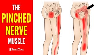 The Pinched Nerve Muscle (How to Release It for INSTANT RELIEF)