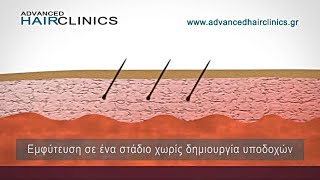 Μεταμόσχευση μαλλιών Advanced FUE (video) - απο τον Δρ. Αναστάσιο Βεκρή