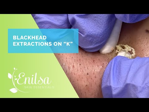 Blackhead & Whitehead Extractions on K