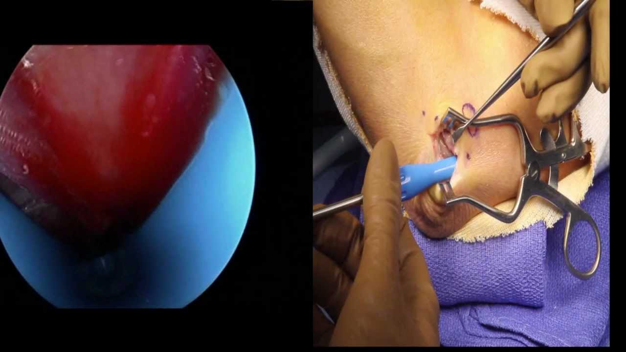 Cubital Tunnel Release