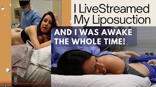 Watch Laser Liposuction LIVE and AWAKE with Dr. Mitchell Chasin of Reflections Center in New Jersey