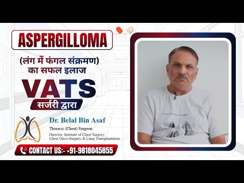 ASPERGILLOMA (Lung Fungal Infection) का सफल इलाज | VATS Surgery Explained | Dr. Belal Bin Asaf