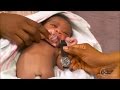 Fast Breathing As The Single Sign Of Illness Newborn Care Series