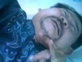Stroke