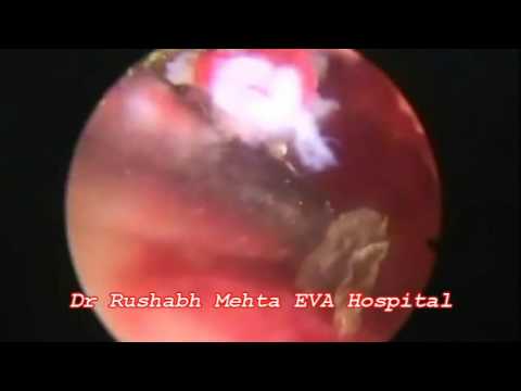 Hysteroscopically Removal of Misplaced Embeded Cu T