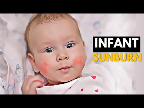 Sunburn Causes Signs and Symptoms Diagnosis and Treatment