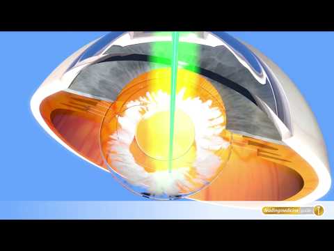 Augen-OP mit Laser: Nachbehandlung nach Katarakt-OP