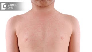 What causes fever body rash with headache and its management? - Dr. Malathi Ramesh