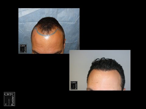 Results of FUE Hair Transplant at CHICAGO HAIR...