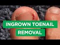 Ep 59 Ingrown Toenail Removal Procedure The Scope