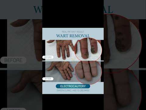 Quick & Effective Wart Removal | Medical Laser & Cautery Treatment ✨