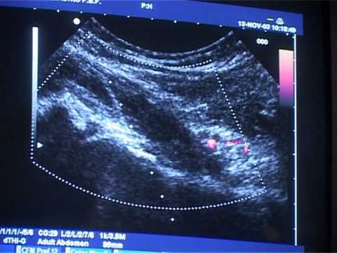 Fluido nel ginocchio che tratta Qualche giorno mal di testa osteocondrosi